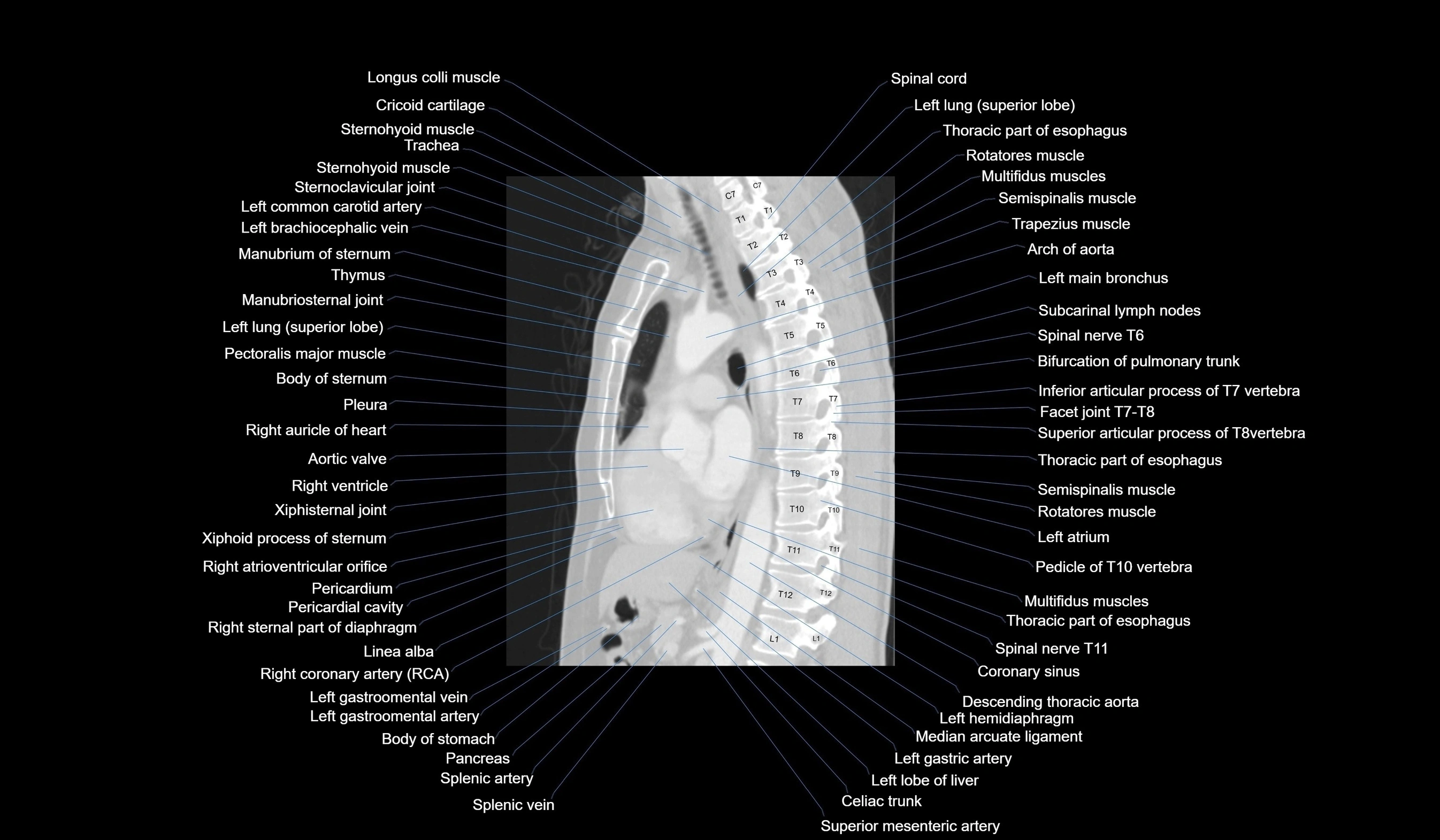 CT chest (thorax) lung window labelled sagittal cross sectional anatomy radiology image-00078.webp
